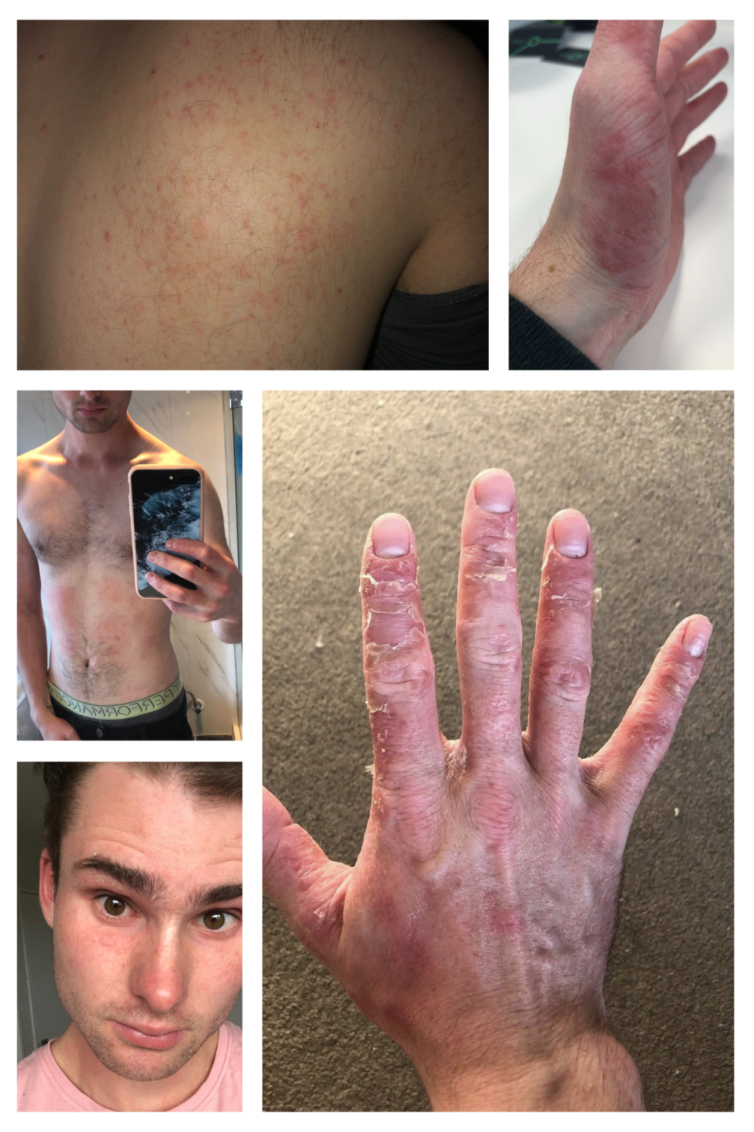 eczema nz collage