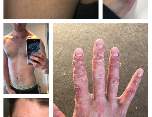 eczema nz collage